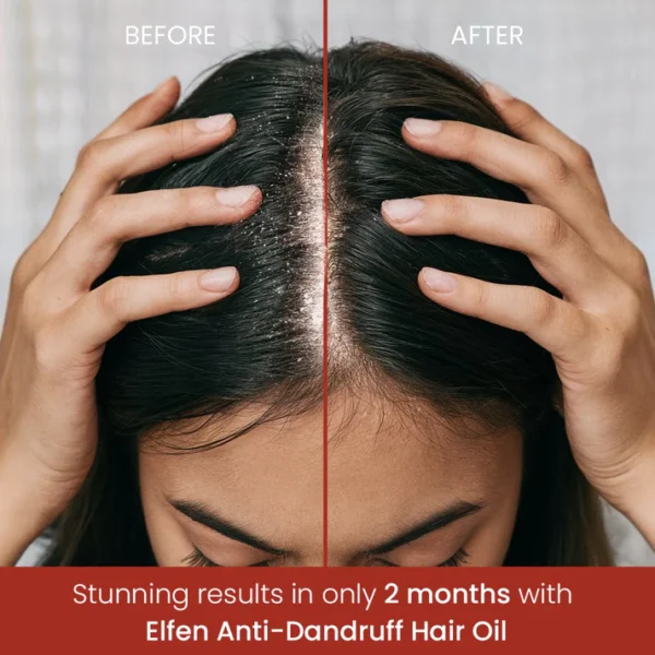 Anti Dandruff Hair Oil with 100% Natural Ingredients Pack of 2 - 100ML each - Image 2